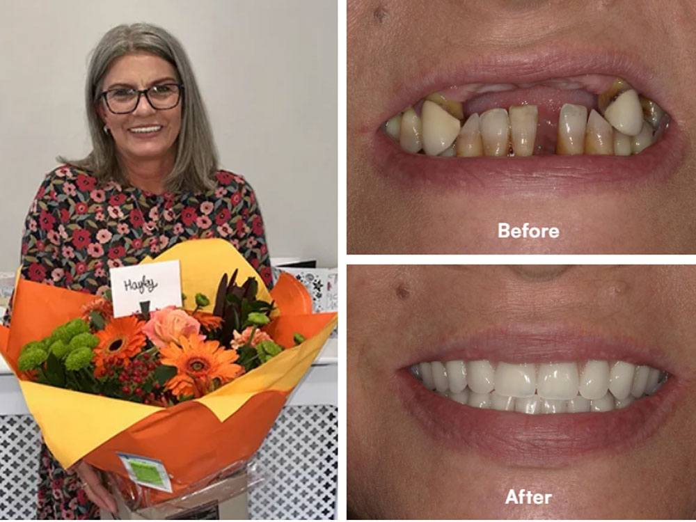dental-implants_img